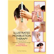 Illustrated Moxibustion Therapy A Natural Way of Prevention and Treatment through Traditional Chinese Medicine by Duan, Xuezhong, 9781602200371