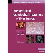 Interventional Radiological Treatment of Liver Tumors by Edited by Andy  Adam , Peter R.  Mueller, 9780521886871