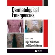 Dermatological Emergencies by Verma, Rajesh; Vasudevan, Biju, 9780815378075