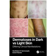 Dermatoses in Dark Vs Light Skin by Ranthilaka R. Gammanpila; Eckart Haneke, 9781003479512